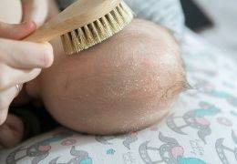 Baby's Kopfhaut – Milchschorf oder Kopfgneis?
